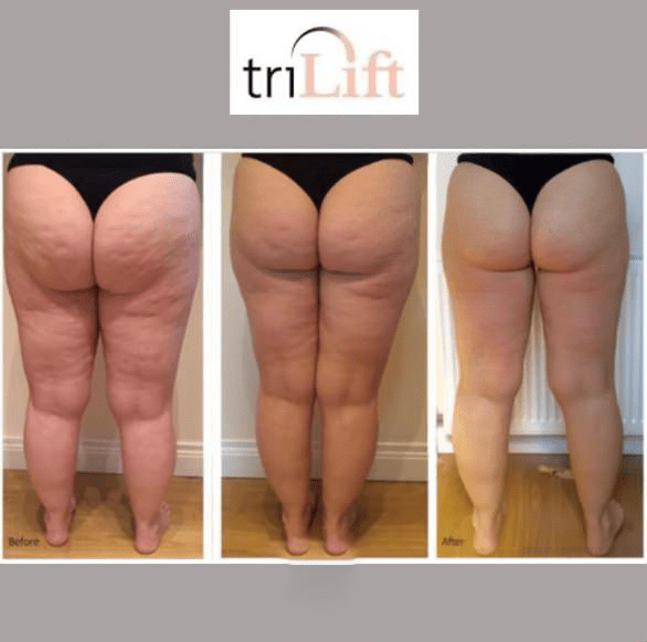 triLift Cellulite