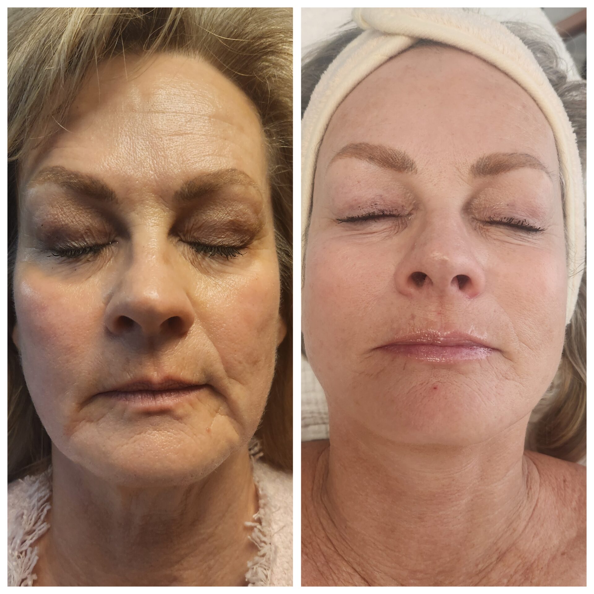 non surgical facelift